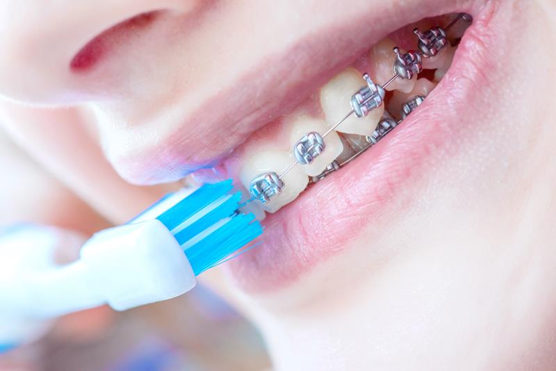 BRACES
